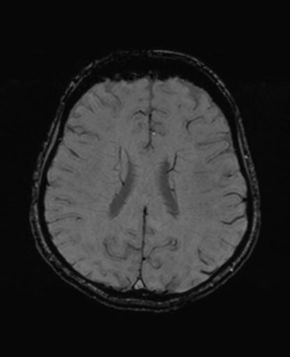Autoimmune limbic encephalitis (Radiopaedia 30363-31005 SWI 50).jpg