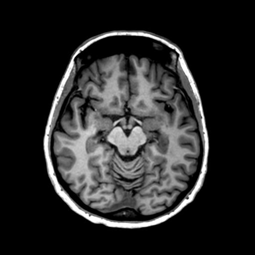 File:Autoimmune limbic encephalitis (Radiopaedia 30363-31005 T1 Axial 1mm 65).jpg
