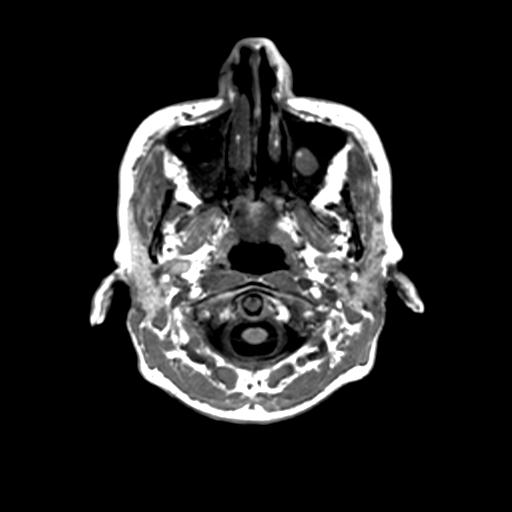 Autoimmune limbic encephalitis (Radiopaedia 30363-31005 T1 Axial 1mm 7).jpg