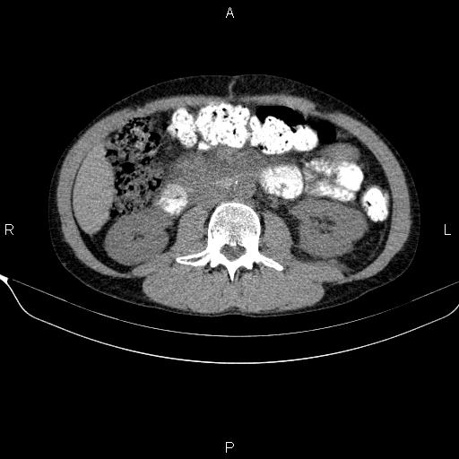 Autoimmune pancreatitis (Radiopaedia 84925-100431 Axial non-contrast 28).jpg