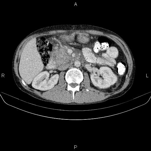 Autoimmune pancreatitis (Radiopaedia 84925-100431 B 24).jpg