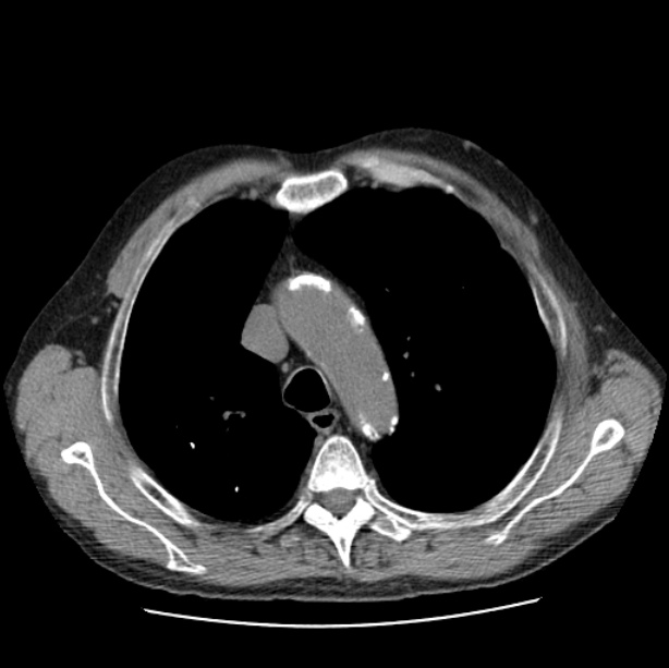 Autosomal dominant polycystic kidney disease (Radiopaedia 27851-28094 Axial non-contrast 16).jpg