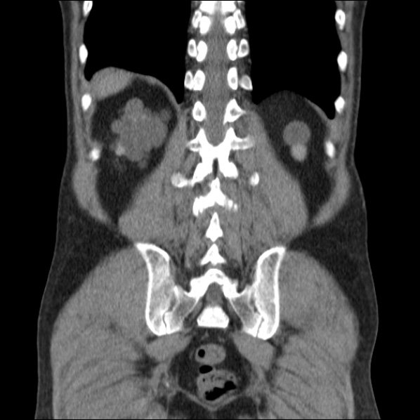 Autosomal dominant polycystic kidney disease (Radiopaedia 36539-38101 C 55).jpg