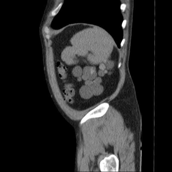 Autosomal dominant polycystic kidney disease (Radiopaedia 36539-38101 D 73).jpg