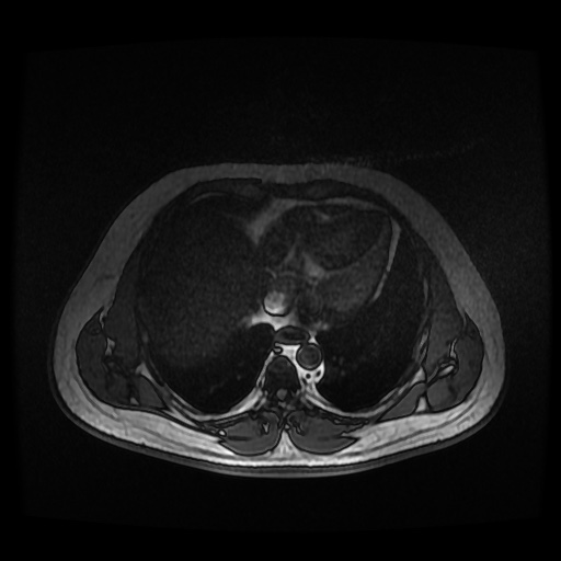 Autosomal dominant polycystic kidney disease (Radiopaedia 50259-55611 Axial 2D Dual Echo 7).jpg