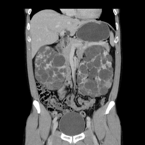 Autosomal dominant polycystic kidney disease (Radiopaedia 66349-75582 A 28).jpg