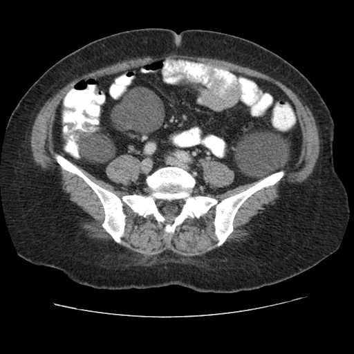 File:Autosomal dominant polycystic kidney disease with hepatic involvement (Radiopaedia 32693-33662 B 55).jpg