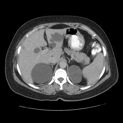 Autosomal dominant polycystic kidney disease with hepatic involvement (Radiopaedia 32693-33662 C 18).jpg