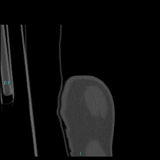 Avascular necrosis after fracture dislocations of the proximal humerus (Radiopaedia 88078-104655 Coronal bone window 14).jpg