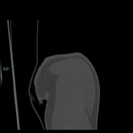 Avascular necrosis after fracture dislocations of the proximal humerus (Radiopaedia 88078-104655 Coronal bone window 28).jpg