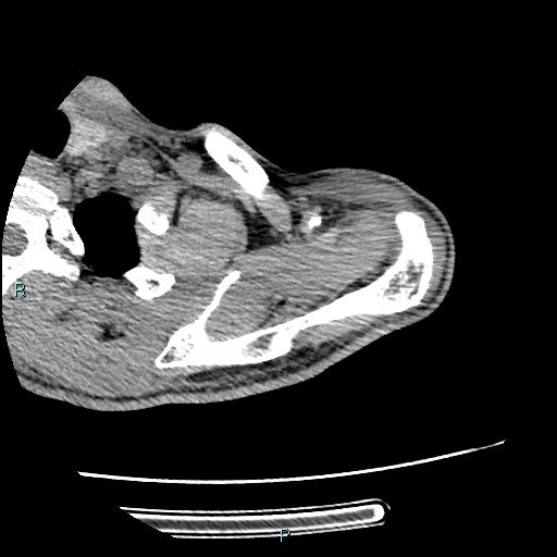 File:Avascular necrosis after fracture dislocations of the proximal humerus (Radiopaedia 88078-104655 D 31).jpg