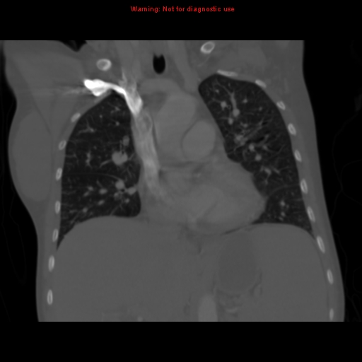 File:Avascular necrosis in sickle cell disease (Radiopaedia 17448-17152 Coronal bone window 58).jpg