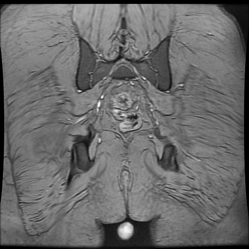 Avascular necrosis of the hip (Radiopaedia 61503-69465 F 92).jpg