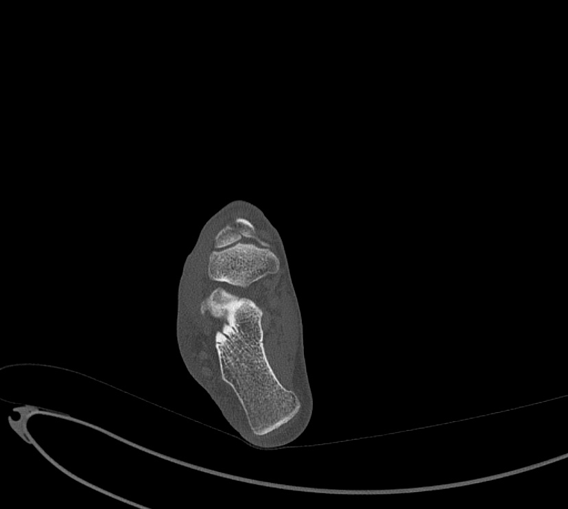 Avulsion fractures of talus and calcaneus (Radiopaedia 48277-53155 Axial bone window 65).jpg