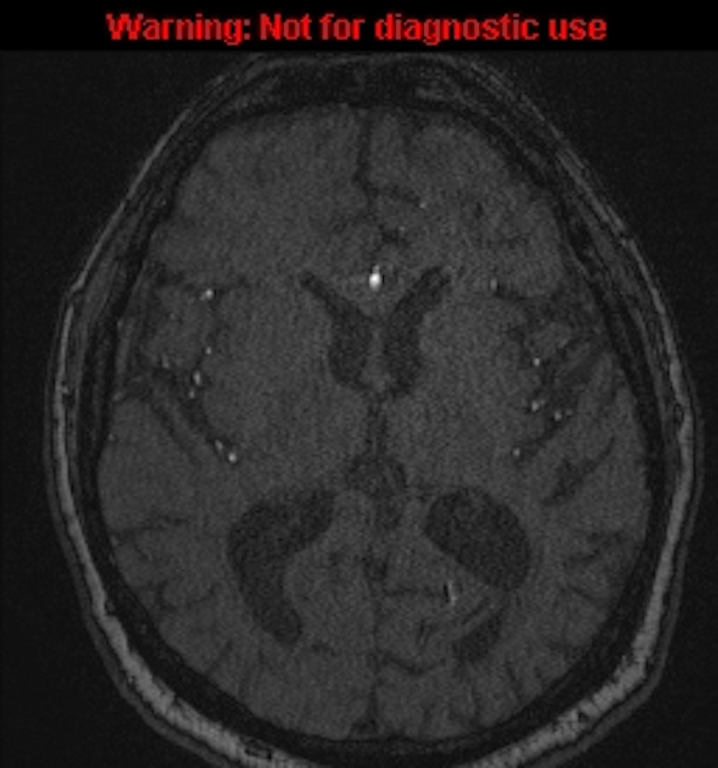 Azygos anterior cerebral artery (Radiopaedia 59325-66677 Axial MRA 94).jpg