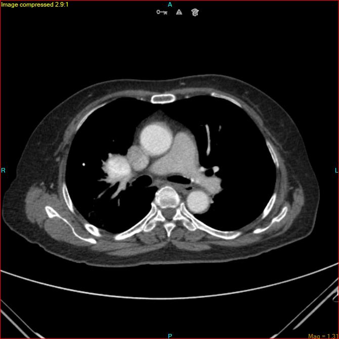 Azygos vein aneurysm (Radiopaedia 77824-90130 B 28).jpg