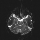 Balo concentric sclerosis (Radiopaedia 50458-55940 Axial DWI 15).jpg