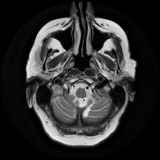 File:Balo concentric sclerosis (Radiopaedia 53875-59982 Axial T2 3).jpg