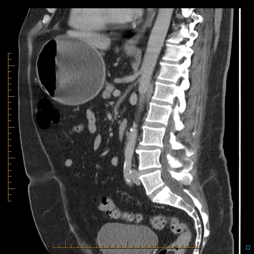 Bariatric balloon causing gastric outlet obstruction (Radiopaedia 54449-60672 C 39).jpg