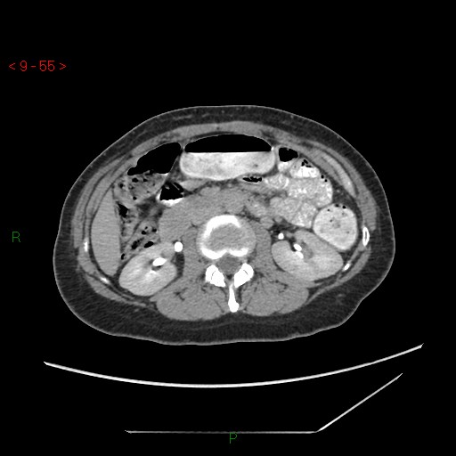 File:Bartholin gland cyst (Radiopaedia 54904-61181 Axial C+ delayed 14).jpg
