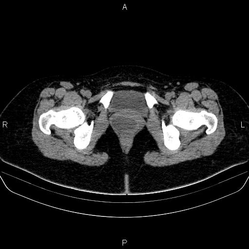 Bartholin gland cyst (Radiopaedia 62635-70930 Axial non-contrast 77).jpg