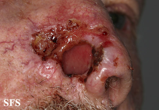 Basal Cell Carcinoma (Dermatology Atlas 244).jpg