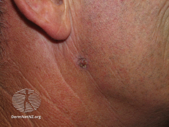 File:Basal cell carcinoma affecting the face (DermNet NZ lesions-bcc-face-0675).jpg