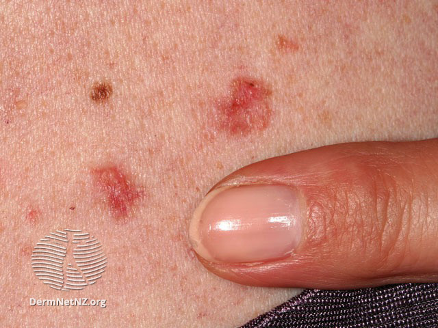File:Basal cell carcinoma affecting the trunk (DermNet NZ lesions-bcc-trunk-0658).jpg