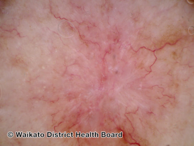 File:Basal cell carcinoma dermoscopy (DermNet NZ bcc-arm-7-wdhb).jpg