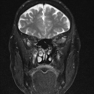 File:Base of skull chondrosarcoma (Radiopaedia 30410-31070 Coronal T2 fat sat 10).jpg