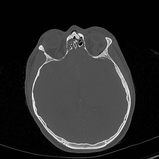 Base of skull fracture with bilateral Le Fort fractures (Radiopaedia 47094-51638 Axial bone window 46).jpg