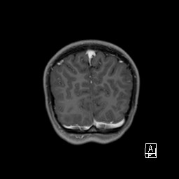 Base of skull rhabdomyosarcoma (Radiopaedia 32196-33142 I 62).jpg