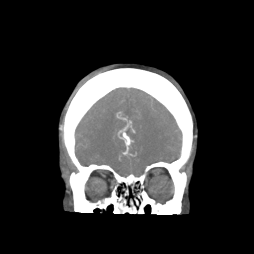 Basilar and bilateral vertebral artery occlusion (Radiopaedia 45592-49723 B 24).png