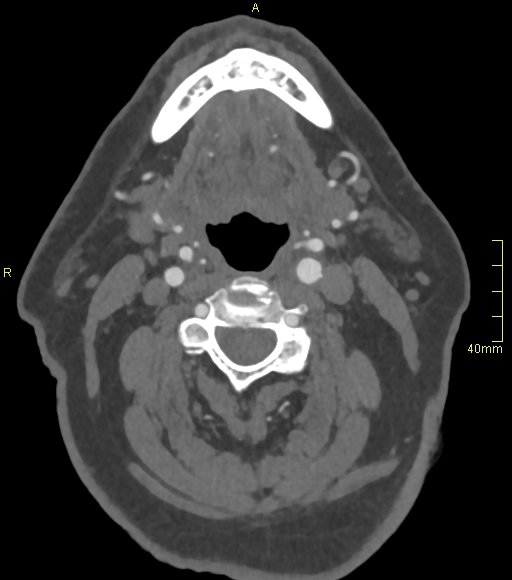 Basilar artery aneurysm (Radiopaedia 56261-62932 A 4).jpg