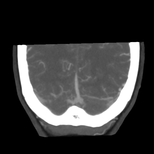 File:Basilar artery fenestration and aneurysms with subarachnoid hemorrhage (Radiopaedia 40066-42573 B 47).png