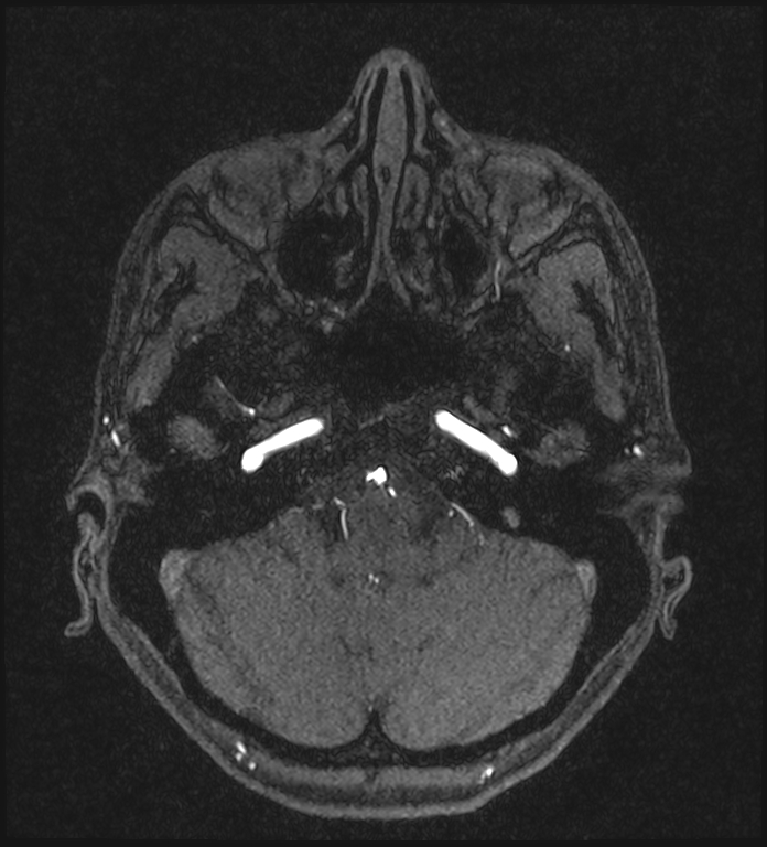 Basilar artery perforator aneurysm (Radiopaedia 82455-97733 Axial MRA 55).jpg