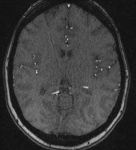 Basilar tip aneurysm (Radiopaedia 26504-26632 MRA 131).jpg