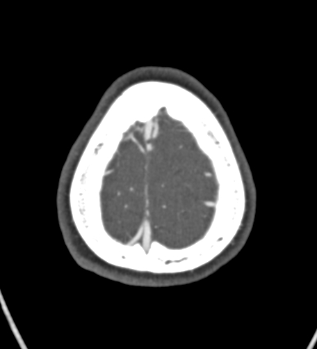 File:Basilar tip aneurysm with coiling (Radiopaedia 53912-60086 A 137).jpg
