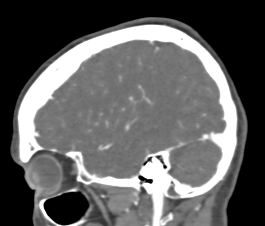 File:Basilar tip aneurysm with coiling (Radiopaedia 53912-60086 C 28).jpg