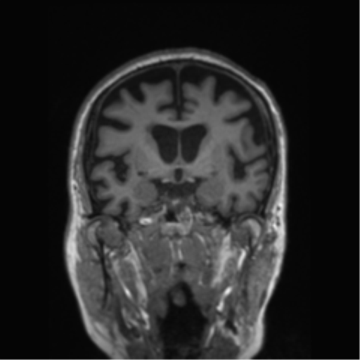 Behavioral variant frontotemporal dementia and late onset schizophrenia (Radiopaedia 52197-58083 Coronal T1 55).png