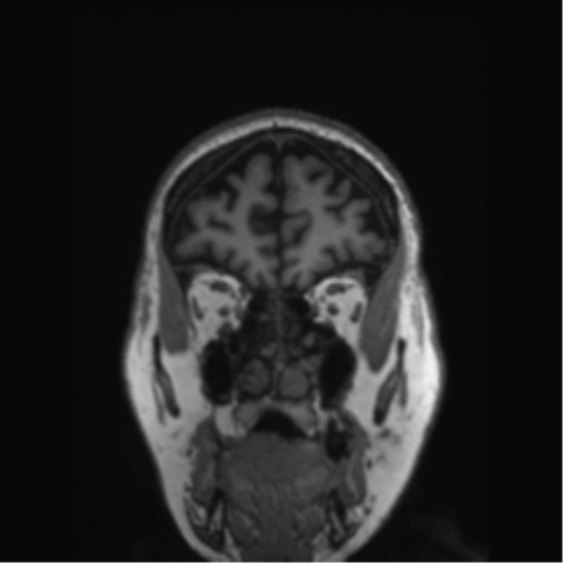 Behavioral variant frontotemporal dementia and late onset schizophrenia (Radiopaedia 52197-58083 Coronal T1 75).png