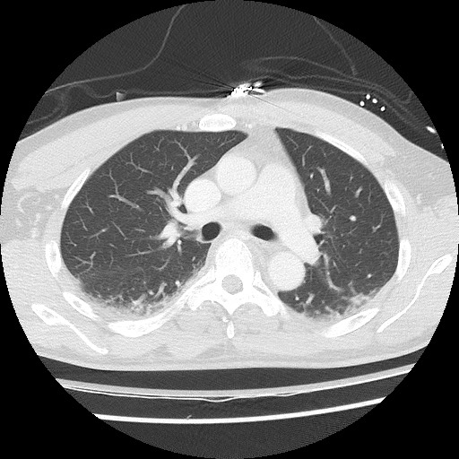 Benign post-traumatic pseudopneumoperitoneum (Radiopaedia 71199-81495 Axial lung window 33).jpg
