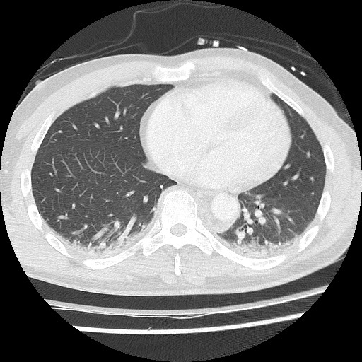 Benign post-traumatic pseudopneumoperitoneum (Radiopaedia 71199-81495 Axial lung window 48).jpg