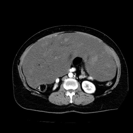 Benign spindle cell tumor - abdominopelvic (Radiopaedia 61300-69212 A 30).jpg