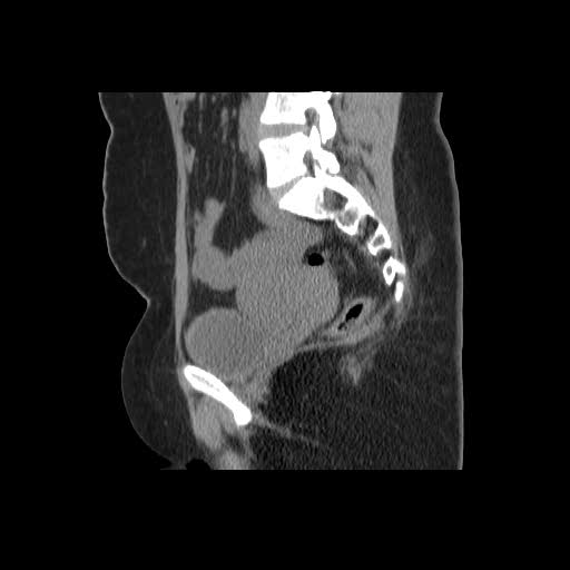File:Bicornuate uterus- on MRI (Radiopaedia 49206-54296 A 8).jpg
