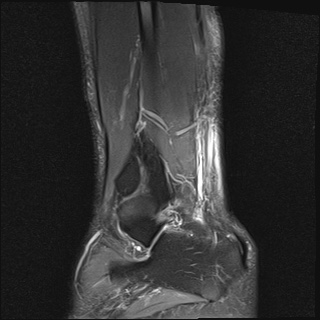 File:Bilateral Achilles tendon complete tear (Radiopaedia 81344-95051 Sagittal T2 fat sat 4).jpg