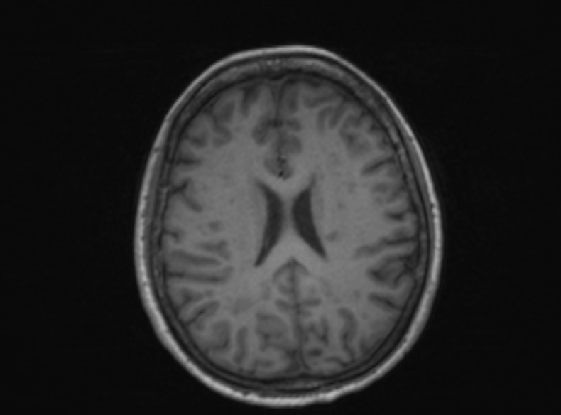 File:Bilateral PCA territory infarction - different ages (Radiopaedia 46200-51784 Axial T1 204).jpg