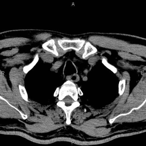 Bilateral Warthin tumors (Radiopaedia 84034-99263 Axial non-contrast 64).jpg