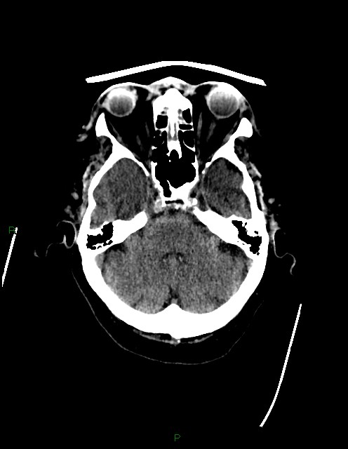 Bilateral acute middle cerebral artery territory infarcts (Radiopaedia 77319-89401 Axial non-contrast 22).jpg