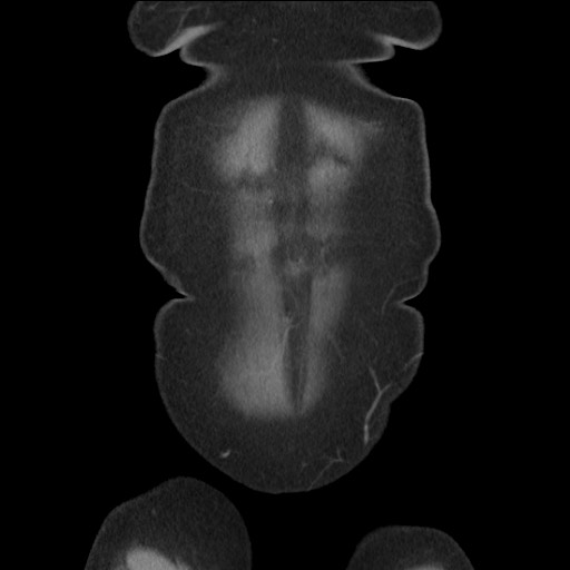 Bilateral adrenal granulocytic sarcomas (chloromas) (Radiopaedia 78375-91007 B 15).jpg